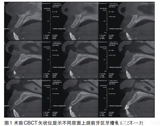 前牙区骨量不足的种植影像评价