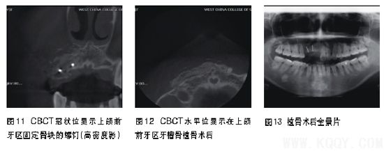 前牙区骨量不足的种植影像评价