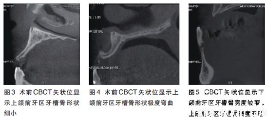前牙区骨量不足的种植影像评价