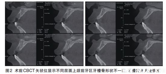 前牙区骨量不足的种植影像评价