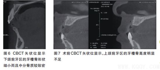 前牙区骨量不足的种植影像评价
