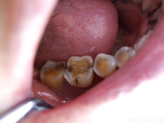 《实用牙髓病诊疗学》第2版分享3