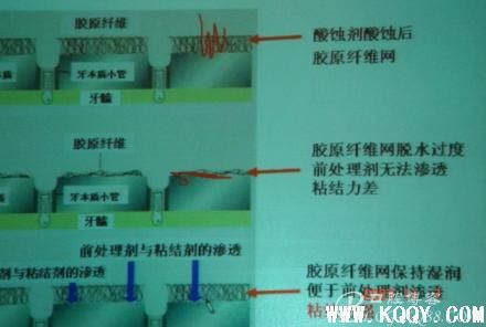 莒国牙医刘相伟对树脂充填的理解