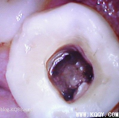 寻找根管口&临床实战图片