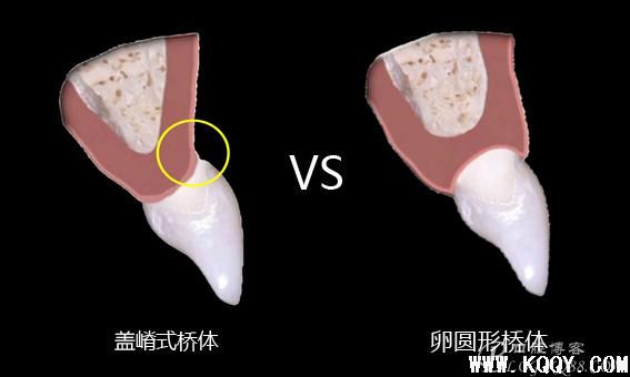 稍有遗憾的前牙龈卵圆形桥体塑形美学修复