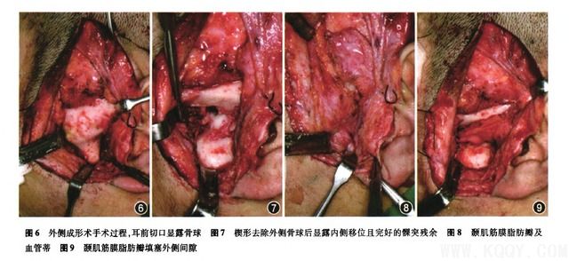 颞下颌关节强直的手术治疗
