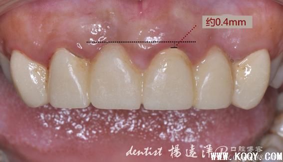 稍有遗憾的前牙龈卵圆形桥体塑形美学修复