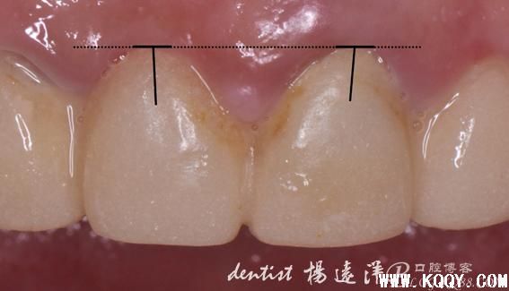 稍有遗憾的前牙龈卵圆形桥体塑形美学修复