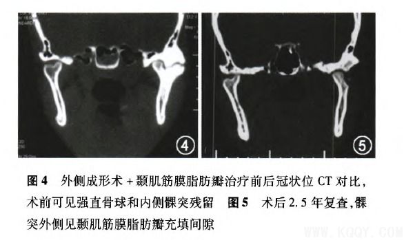 颞下颌关节强直的手术治疗