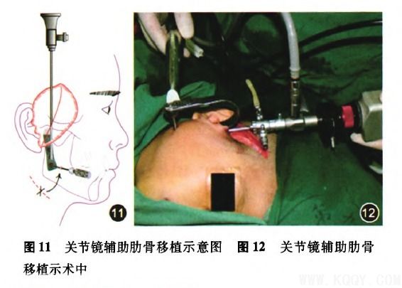 颞下颌关节强直的手术治疗