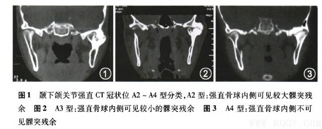 颞下颌关节强直的手术治疗