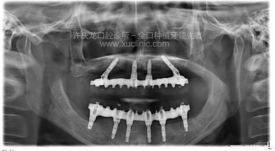 全口无牙的现代解决方案（续）