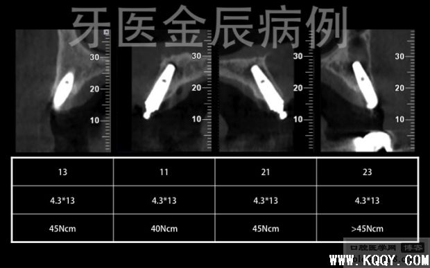 上颌手术导板全口种植，即刻负重 All-on-4