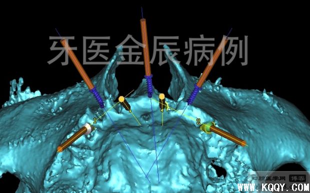 上颌手术导板全口种植，即刻负重 All-on-4