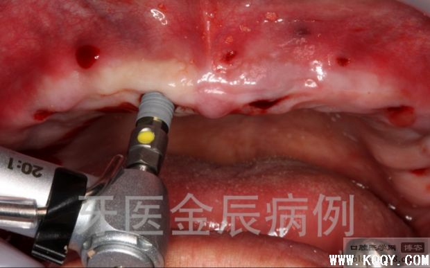 上颌手术导板全口种植，即刻负重 All-on-4