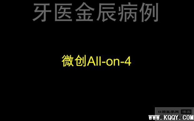 上颌手术导板全口种植，即刻负重 All-on-4