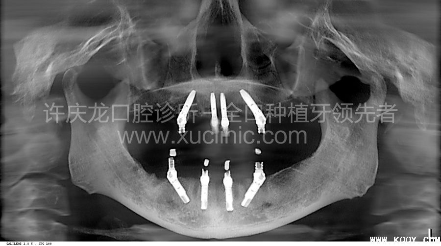 核心提示:高效的全口种植牙方案all-on-4