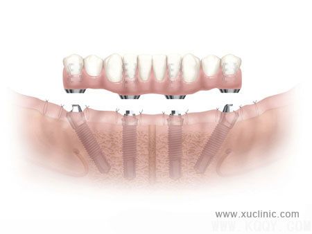 All-on-4种植牙方案介绍