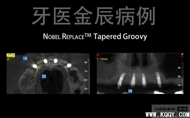 上颌手术导板全口种植，即刻负重 All-on-4