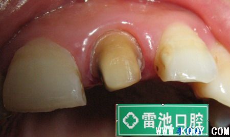 备牙、排龈与车针