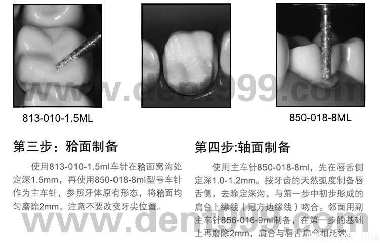 周锐前后牙备牙简明教程