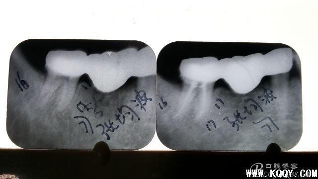 根管治疗 S3锉正在使用中