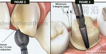 烤瓷牙备牙中的一些技巧