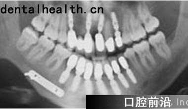螺旋状种植体在修复前牙缺失中的应用