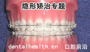 陶瓷托槽矫治器