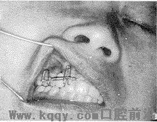 种植体单冠义齿唇侧错位的正畸治疗