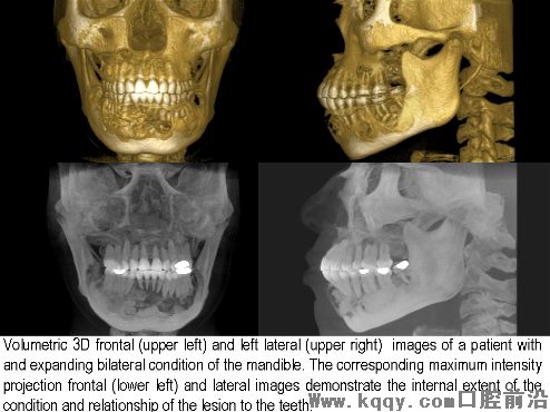 Temporomandibular joint (TMJ) Disorders