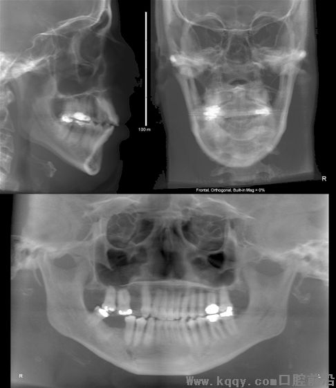 Temporomandibular joint (TMJ) Disorders