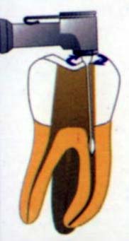 LightSpeed 根管预备技术