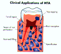 Root Canal Repair Material-MTA