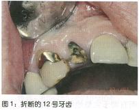 个别牙齿脱落后的即刻治疗