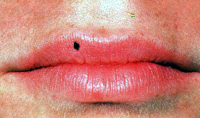 口腔粘膜病基本病变