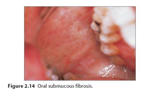 口腔黏膜溃疡图片