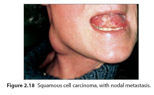 口腔黏膜溃疡图片