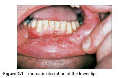 口腔黏膜溃疡图片