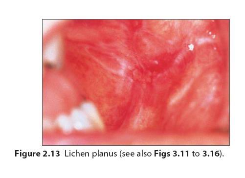 口腔黏膜溃疡图片