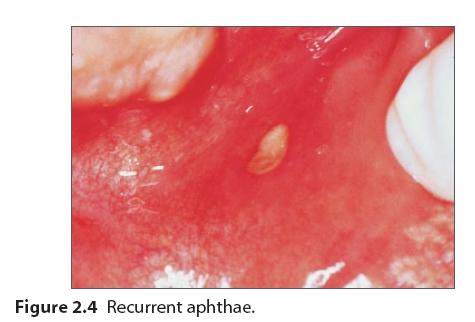 口腔黏膜溃疡图片