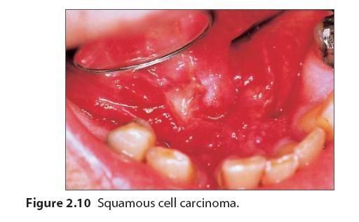 口腔黏膜溃疡图片