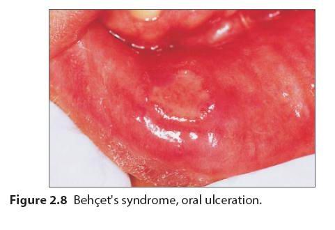 口腔黏膜溃疡图片