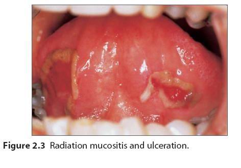 口腔黏膜溃疡图片