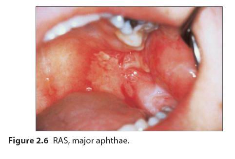 口腔黏膜溃疡图片