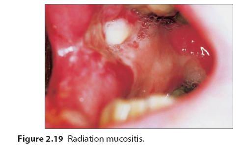 口腔黏膜溃疡图片