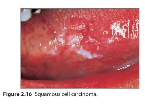 口腔黏膜溃疡图片