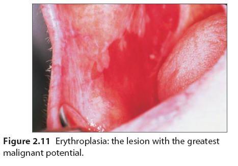 口腔黏膜溃疡图片