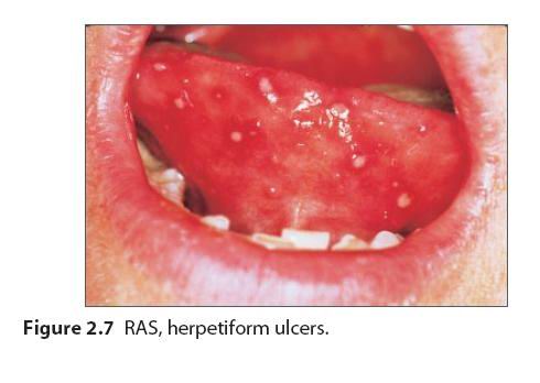 口腔黏膜溃疡图片