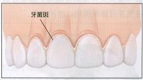 治疗牙周病